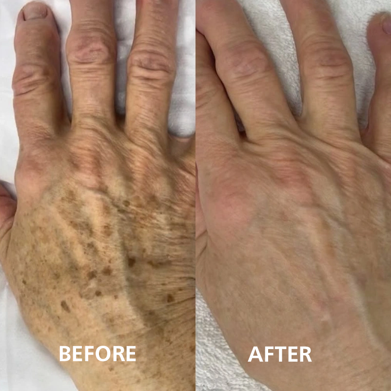 Before and after hand dark spots result