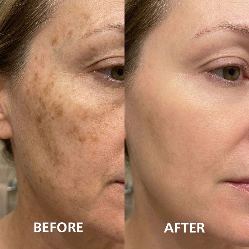 Before and after facial dark spots result